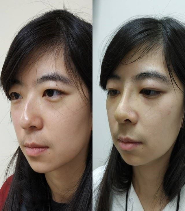 三總內視鏡鼻中膈手術 助患者治鼻塞、重建鼻型2