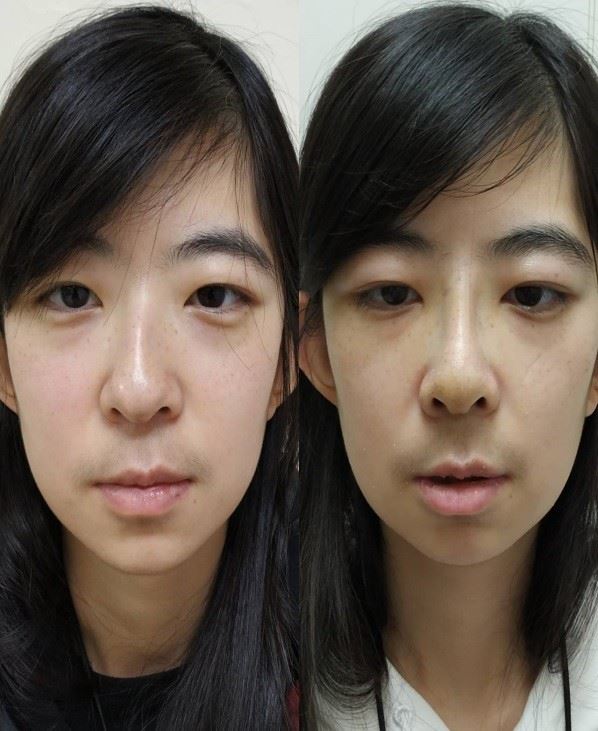 三總內視鏡鼻中膈手術 助患者治鼻塞、重建鼻型1